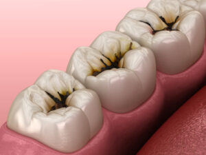 dental caries